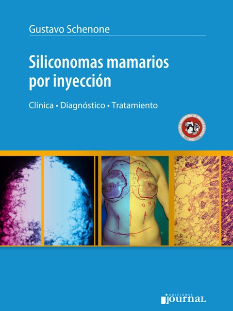 Siliconomas mamarios por inyección